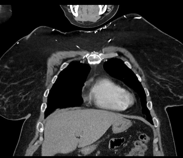 Acromioclavicular joint cyst (Radiopaedia 58455-65610 Coronal C+ arterial phase 43).jpg