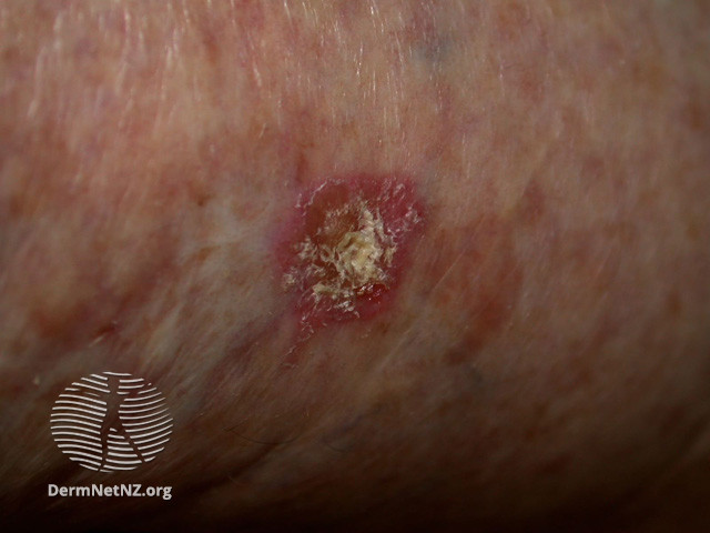File:Actinic Keratoses treated with imiquimod (DermNet NZ lesions-ak-imiquimod-3732).jpg