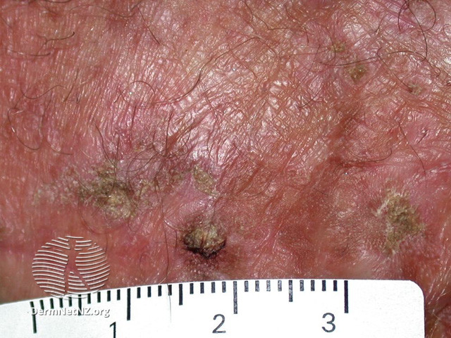 File:Actinic keratoses affecting the hands (DermNet NZ lesions-ak-hands-517).jpg