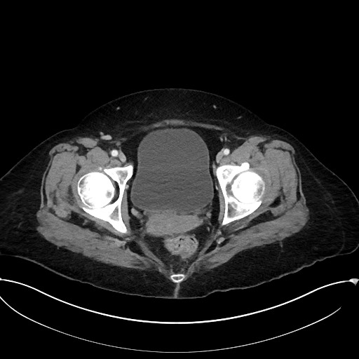 File:Active Crohn disease (Radiopaedia 59394-66750 Axial C+ portal venous phase 67).jpg