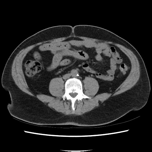 Active colonic bleed on CT (Radiopaedia 49765-55025 Axial non-contrast 48).jpg
