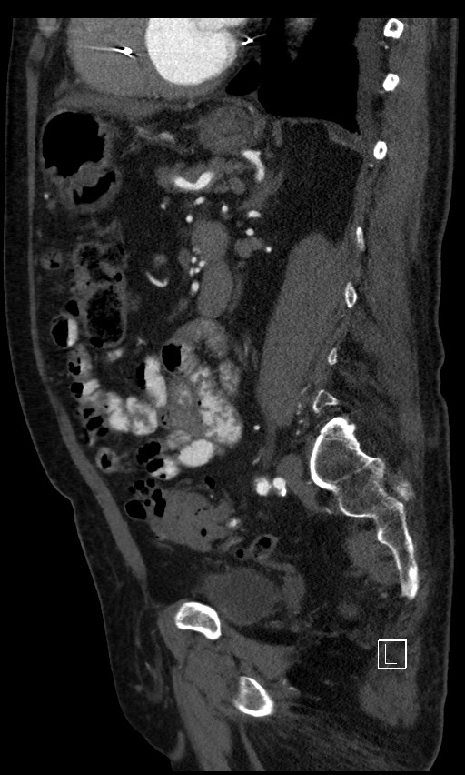 Active lower gastrointestinal bleeding - diverticular (Radiopaedia 61203-69106 Sagittal C+ arterial phase 64).jpg