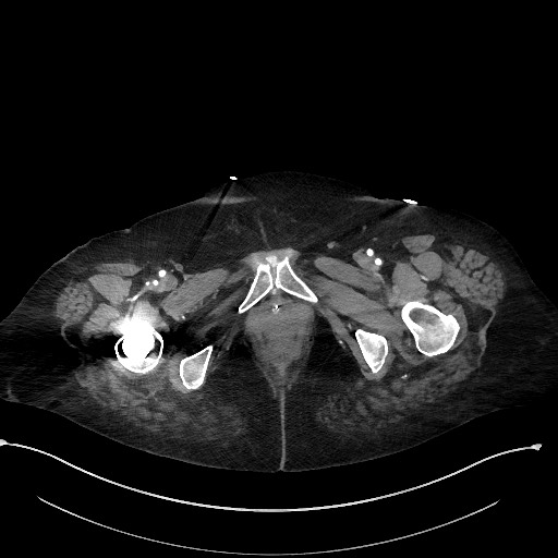 File:Active renal extravasation with large subcapsular and retroperitoneal hemorrhage (Radiopaedia 60975-68796 Axial C+ arterial phase 204).jpg