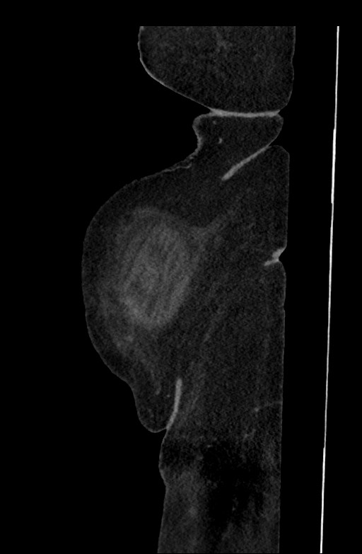Active renal extravasation with large subcapsular and retroperitoneal hemorrhage (Radiopaedia 60975-68796 Sagittal C+ portal venous phase 208).jpg