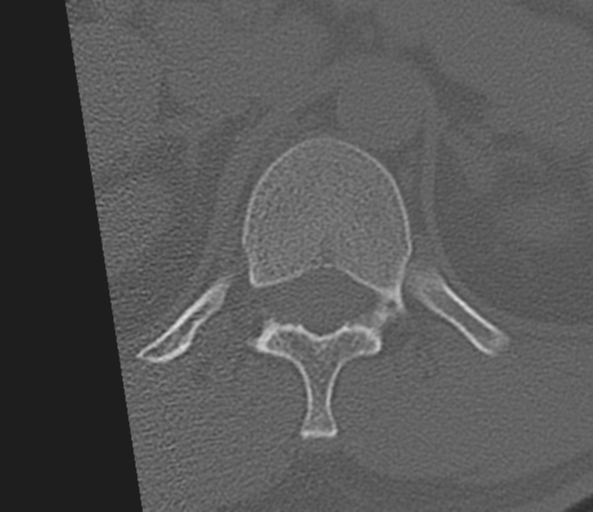 File:Acute L1 burst compression fracture (Radiopaedia 34430-35755 Axial bone window 2).png