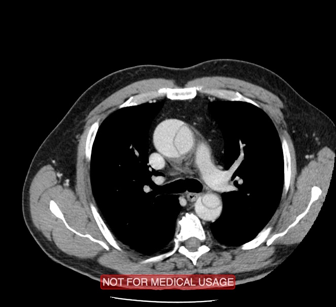 Acute aortic dissection - Stanford type A (Radiopaedia 40661-43285 Axial C+ portal venous phase 14).jpg
