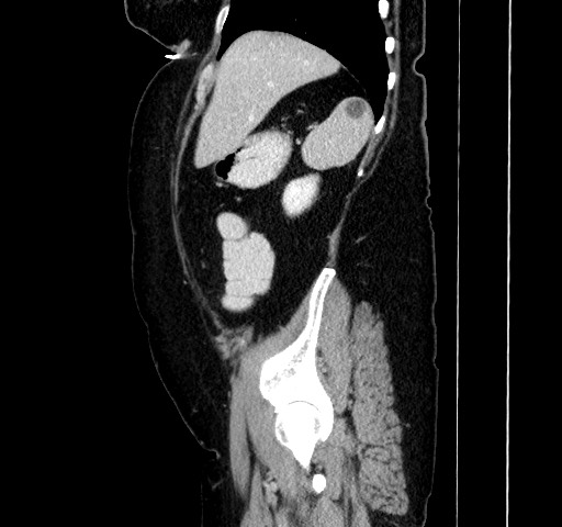 Acute appendicitis, heterotaxy syndrome (Radiopaedia 66884-76202 Sagittal C+ portal venous phase 37).jpg