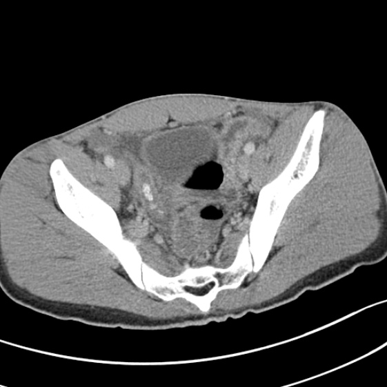 File:Acute appendicitis (Radiopaedia 32614-33572 Axial C+ portal venous phase 56).jpg