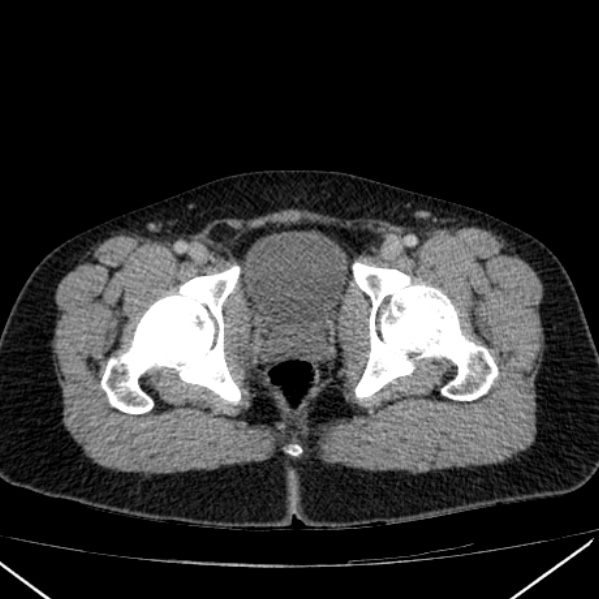 Acute appendicitis (Radiopaedia 38255-40270 Axial C+ portal venous phase 108).jpg