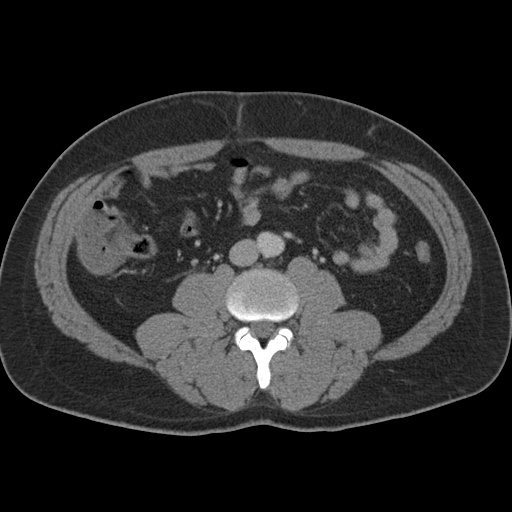 Acute appendicitis (Radiopaedia 48511-53463 Axial C+ portal venous phase 57).jpg