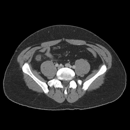 Acute appendicitis (Radiopaedia 48511-53463 Axial C+ portal venous phase 72).jpg