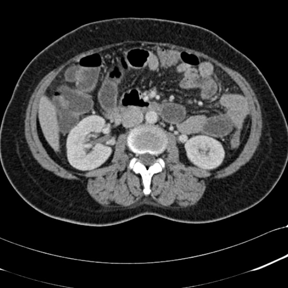 File:Acute appendicitis (Radiopaedia 48792-53822 Axial C+ portal venous phase 53).jpg