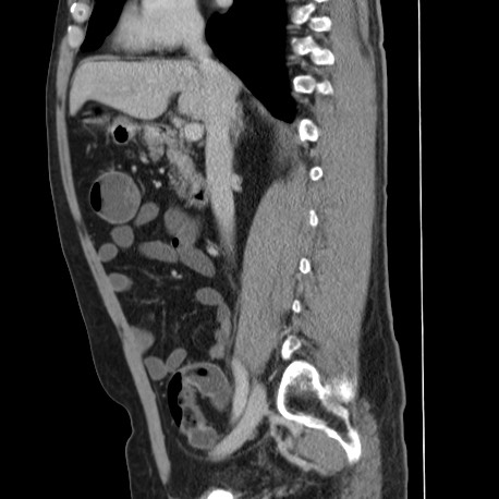 File:Acute appendicitis (Radiopaedia 66513-75790 Sagittal C+ portal venous phase 66).jpg