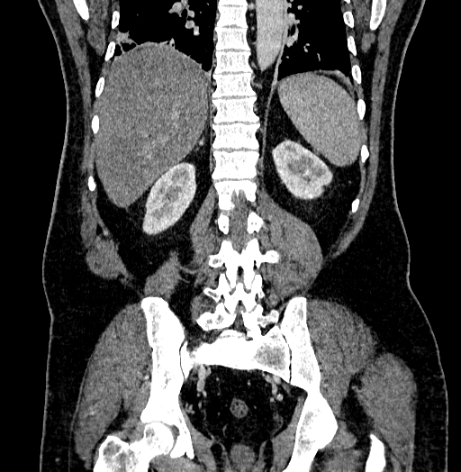 Acute appendicitis (Radiopaedia 79950-93224 Coronal C+ portal venous phase 68).jpg