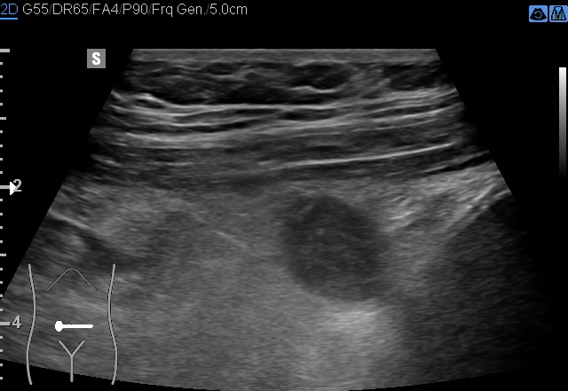 File:Acute appendicitis (Radiopaedia 85193-100745 D 186).jpg