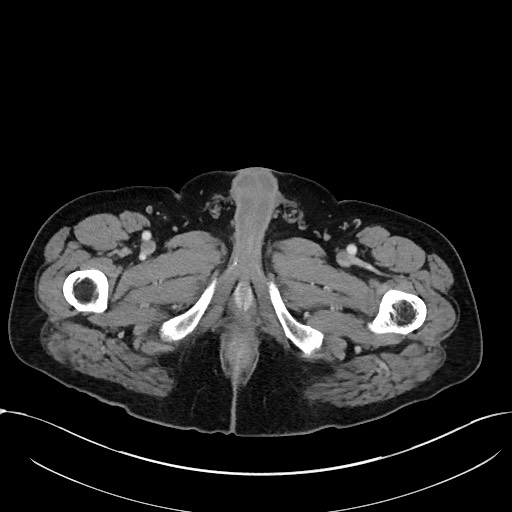 Acute appendicitis - large appendicoliths (Radiopaedia 61805-69820 Axial C+ portal venous phase 147).jpg