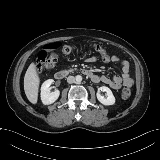 File:Acute appendicitis - large appendicoliths (Radiopaedia 61805-69820 Axial C+ portal venous phase 57).jpg