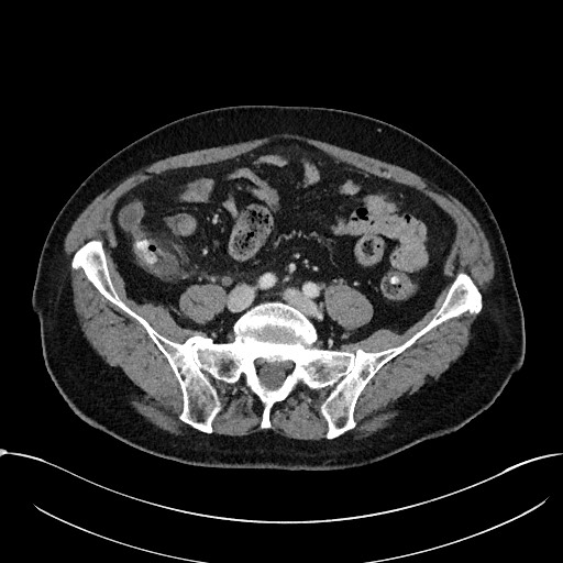 File:Acute appendicitis - large appendicoliths (Radiopaedia 61805-69820 Axial C+ portal venous phase 89).jpg