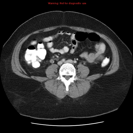File:Acute appendicitis complicated by ovarian vein thrombophlebitis (Radiopaedia 16172-15851 Axial C+ portal venous phase 58).jpg