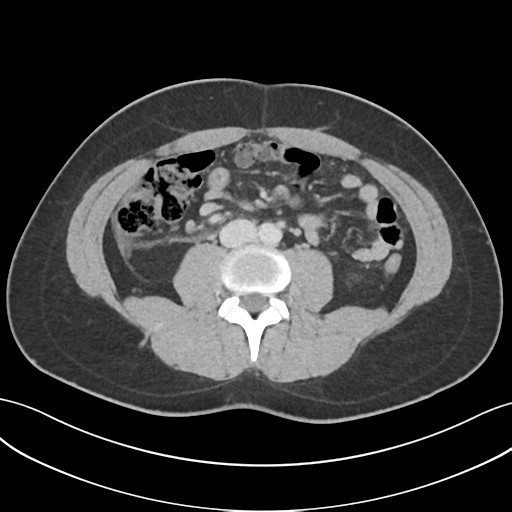 File:Acute appendicitis with appendicoliths (Radiopaedia 50186-55532 Axial C+ portal venous phase 44).png