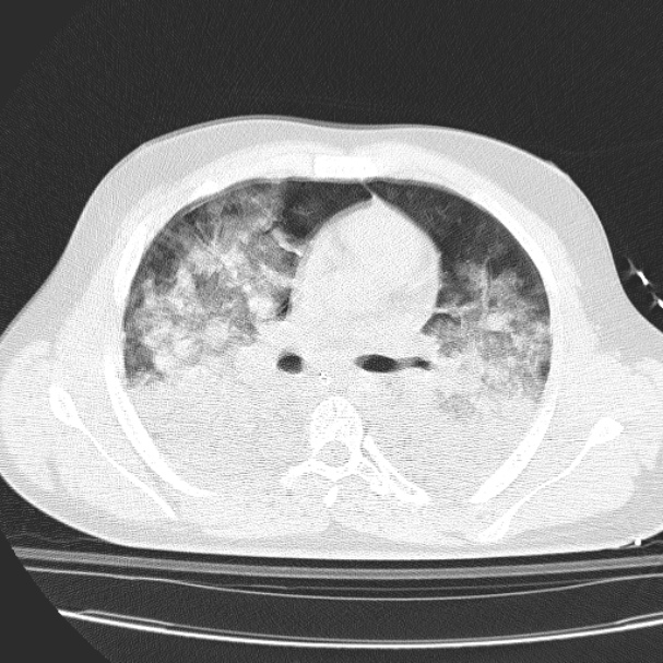 Acute aspiration pneumonitis (Radiopaedia 33605-34703 Axial lung window 47).jpg