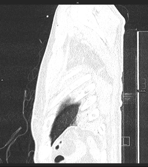 Acute aspiration pneumonitis (Radiopaedia 55642-62166 Sagittal lung window 3).jpg