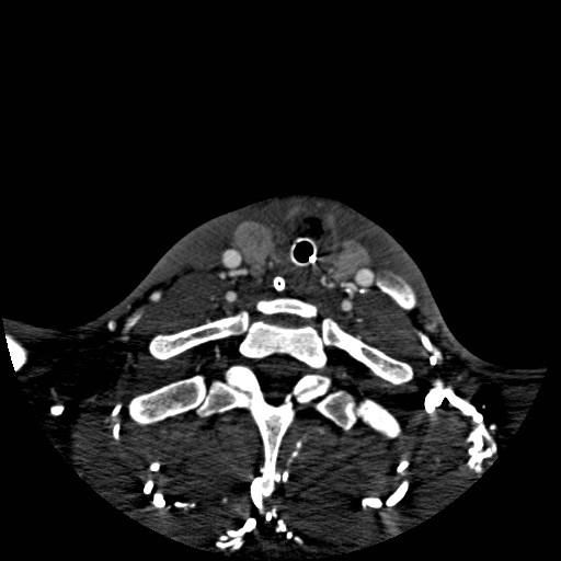 Acute basilar artery occlusion (Radiopaedia 43582-46985 Axial C+ arterial phase 263).jpg