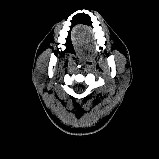 Acute basilar artery occlusion (Radiopaedia 43582-46985 Axial non-contrast 11).jpg