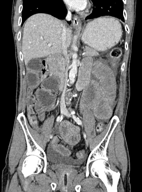 Acute bowel ischemia (Radiopaedia 87695-104114 Coronal C+ portal venous phase 209).jpg