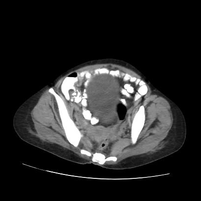 File:Acute calculous cholecystitis in patient with osteopetrosis (Radiopaedia 77871-90159 Axial non-contrast 67).jpg