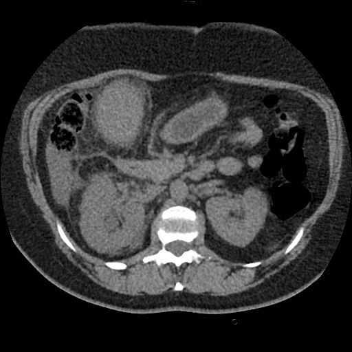 File:Acute cholecystitis and ureteric colic (Radiopaedia 42330-45444 Axial prone 34).jpg
