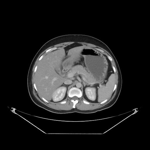 File:Acute complicated calculous cholecystitis (Radiopaedia 55202-61587 Axial C+ delayed 33).jpg