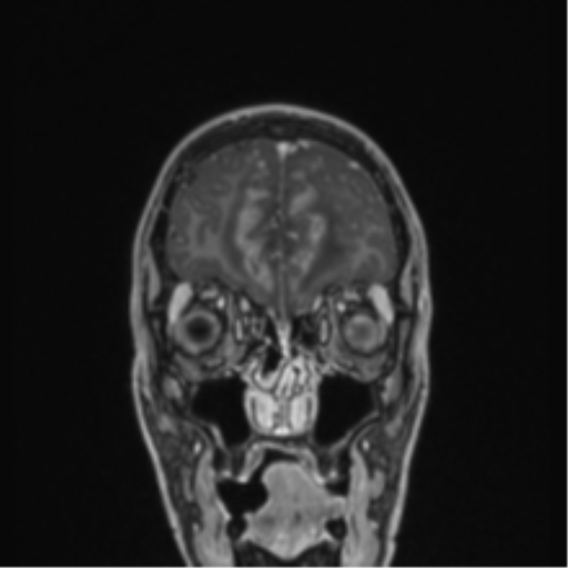 Acute disseminated encephalomyelitis (ADEM) (Radiopaedia 65319-74349 Coronal T1 C+ 56).png