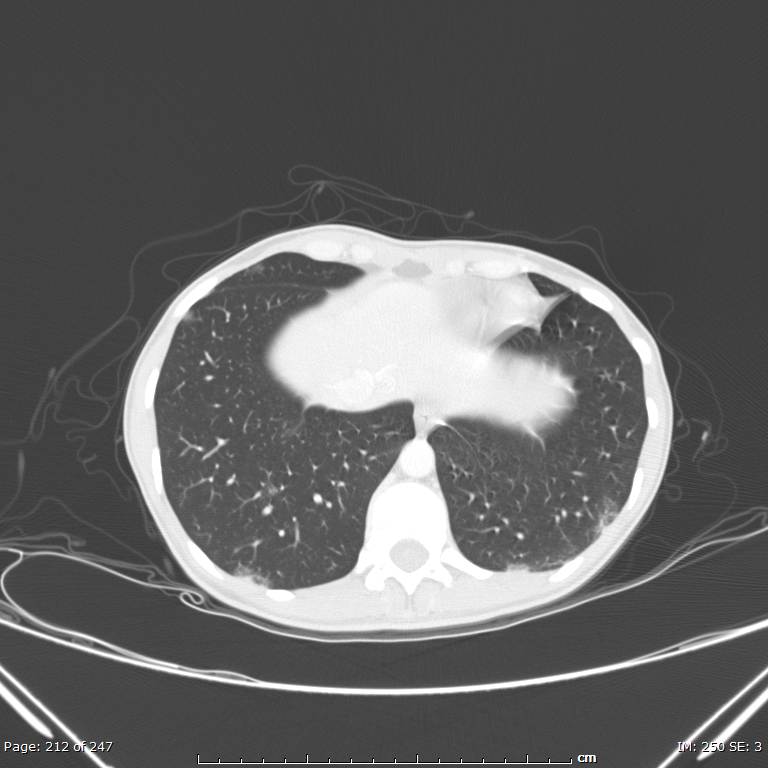 Acute eosinophilic pneumonia (Radiopaedia 48211-53073 Axial lung window 76).jpg