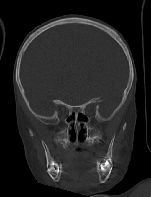 Acute mastoiditis (Radiopaedia 82678-96881 Coronal bone window 24).jpg
