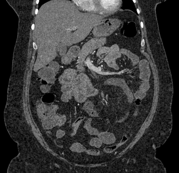Acute mesenteric ischemia (Radiopaedia 80029-93316 Coronal C+ arterial phase 49).jpg