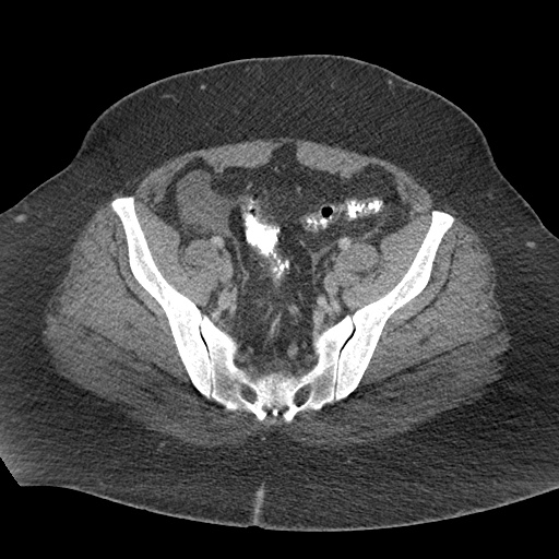 Acute mesenteric venous ischemia (Radiopaedia 46041-50383 Axial C+ portal venous phase 115).jpg