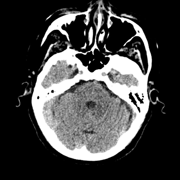 Acute middle cerebral artery territory infarct (Radiopaedia 52380-58283 Axial non-contrast 25).jpg