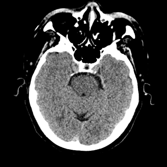 Acute middle cerebral artery territory infarct (Radiopaedia 52380-58283 Axial non-contrast 30).jpg