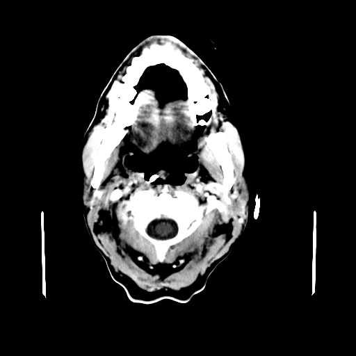 File:Acute necrotizing toxoplasma encephalitis (Radiopaedia 10683-11150 C+ arterial phase 35).jpg
