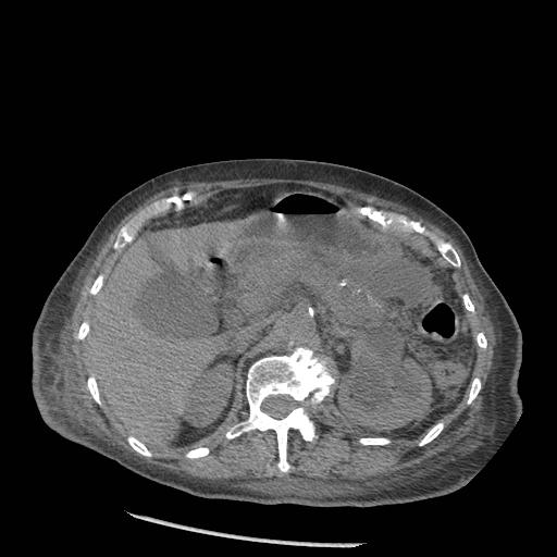 Acute on chronic pancreatitis (Radiopaedia 13233-13244 Axial non-contrast 29).jpg