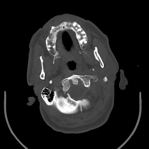 Acute on chronic subdural hematoma (Radiopaedia 78346-90966 D 14).jpg