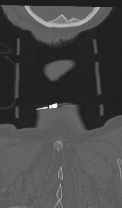 Acute on chronic subdural hematoma and thoracic vertebral injury in a multitrauma patient (Radiopaedia 31698-32619 Coronal bone window 74).jpg