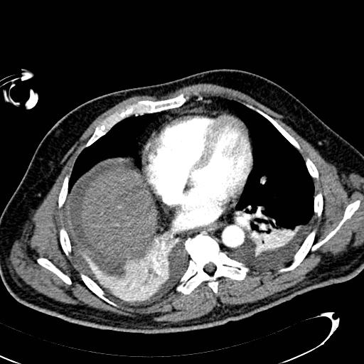 File:Acute pancreatic necrosis (Radiopaedia 13560-13486 Axial C+ portal venous phase 9).jpg