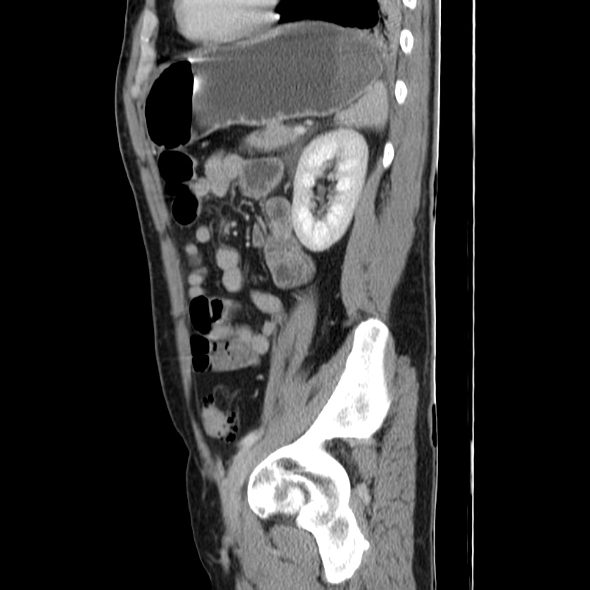 Acute pancreatitis (Radiopaedia 22572-22596 Sagittal C+ portal venous phase 39).jpg