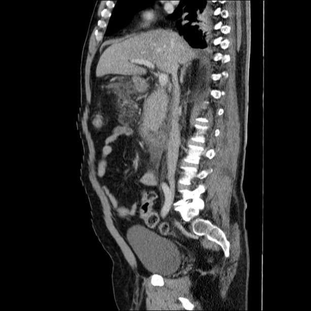 Acute pancreatitis (Radiopaedia 26663-26813 Sagittal C+ portal venous phase 32).jpg