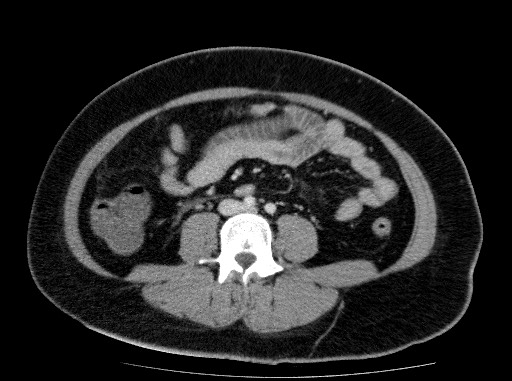 Acute pancreatitis (Radiopaedia 69236-79012 Axial C+ portal venous phase 56).jpg