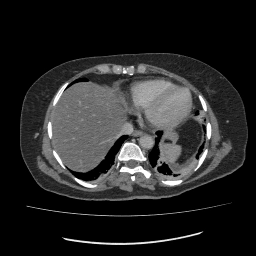 Acute pancreatitis (Radiopaedia 80007-93285 Axial C+ portal venous phase 12).jpg