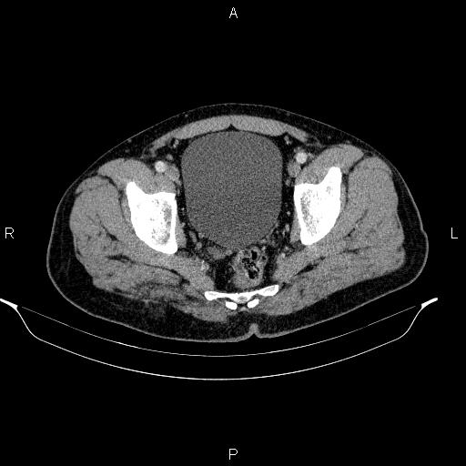 Acute pancreatitis (Radiopaedia 85390-101010 Axial C+ portal venous phase 98).jpg