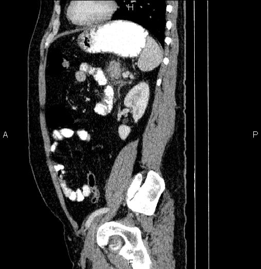 Acute pancreatitis (Radiopaedia 85390-101010 Sagittal C+ portal venous phase 72).jpg